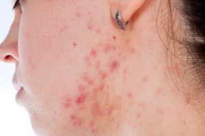 combatir-el-acne